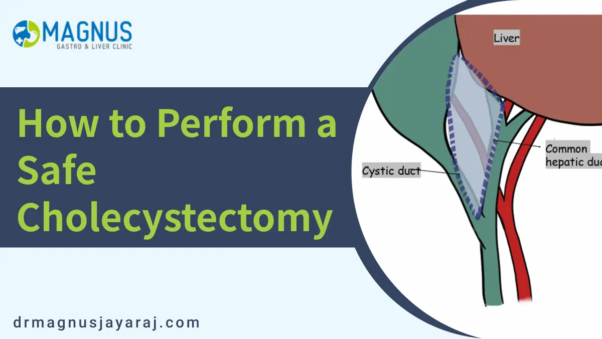 How to perform a safe cholecystectomy | Dr. Magnus Jayaraj
