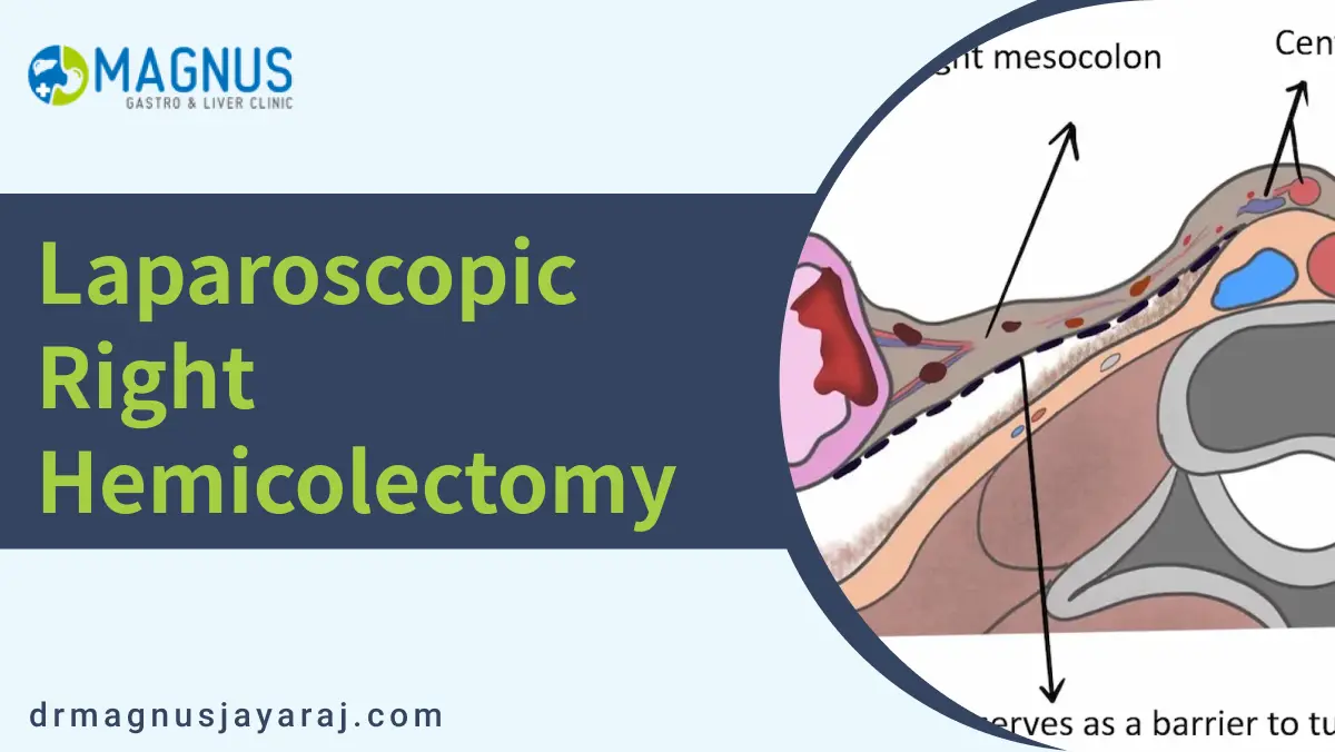 Laparoscopic right hemicolectomy | Dr. Magnus Jayaraj
