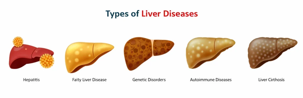Types of Liver Disease