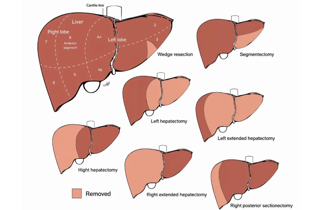 weight loss after liver resection