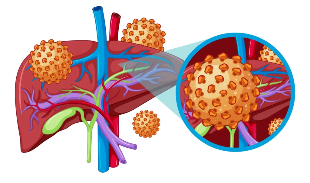 hepatitis a treatment and prevention