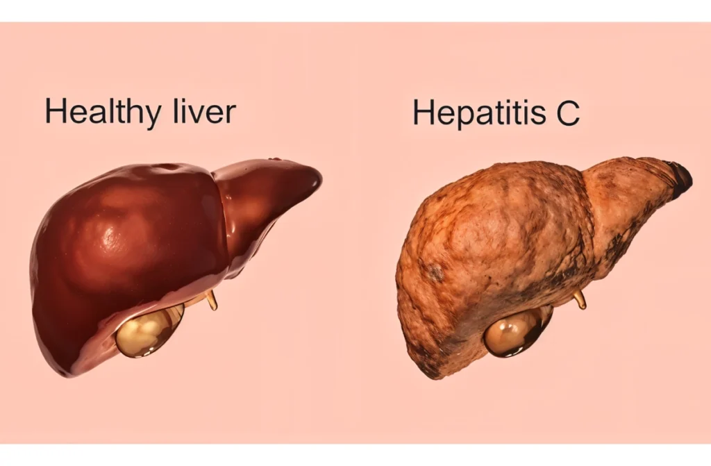 Hepatitis C Treatment In Chennai
