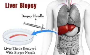 liver biopsy in chennai