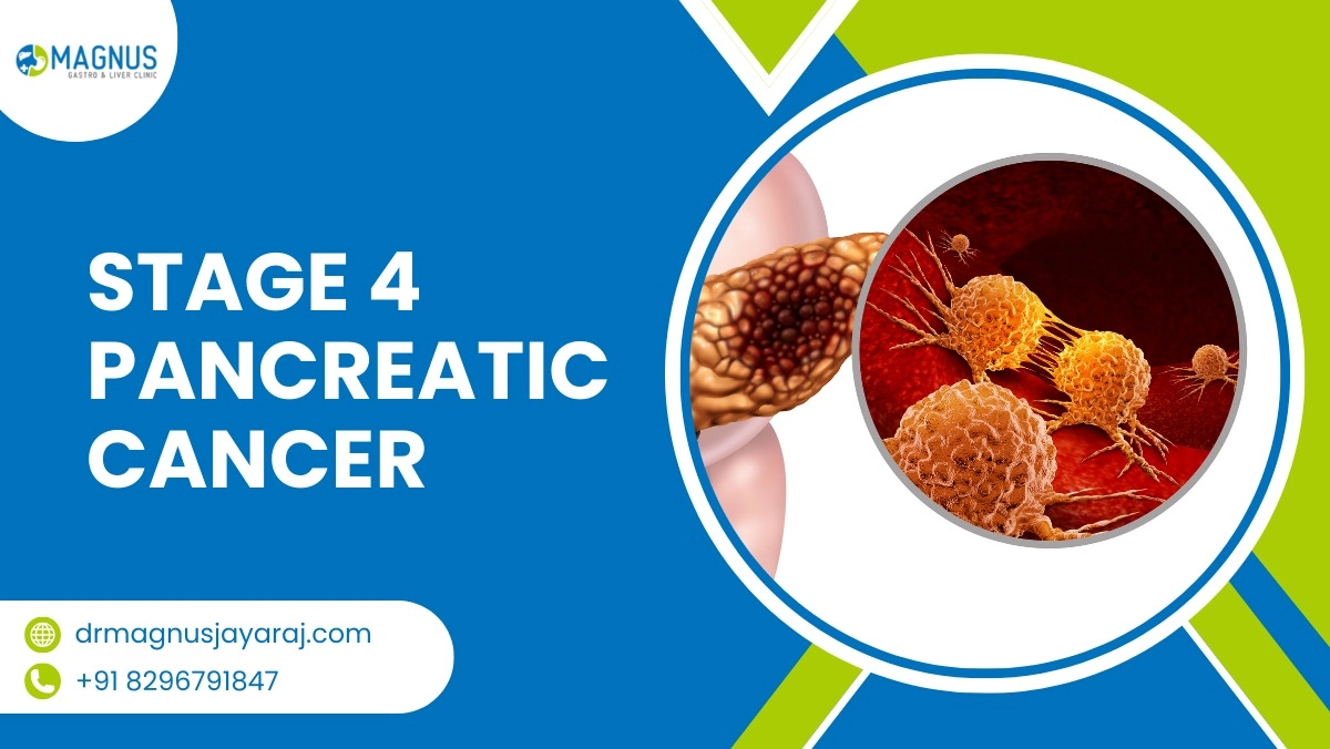 Stage 4 Pancreatic Cancer