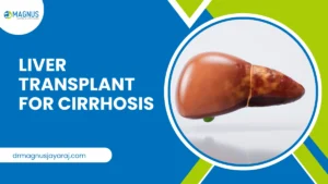 Liver Transplant for Cirrhosis