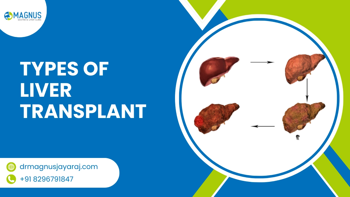 Types of Liver Transplant