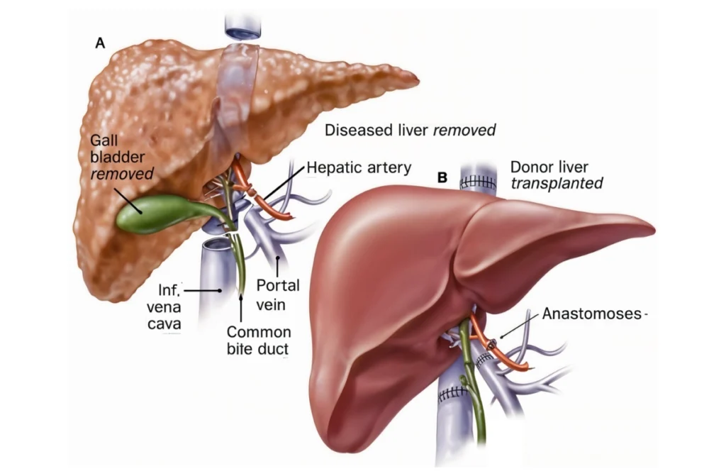Can You Live Without Your Liver