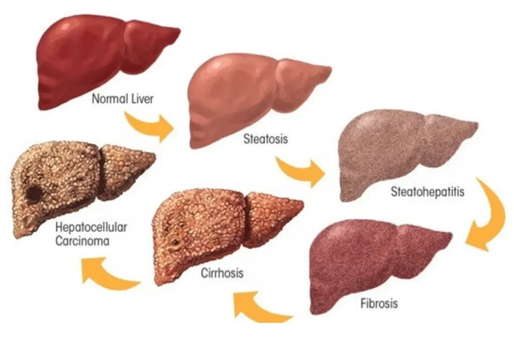 Best Liver Treatment in Chennai