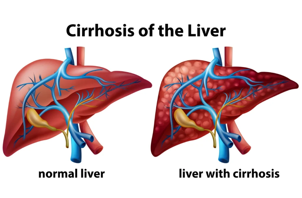 Liver Cirrhosis Treatment in Chennai