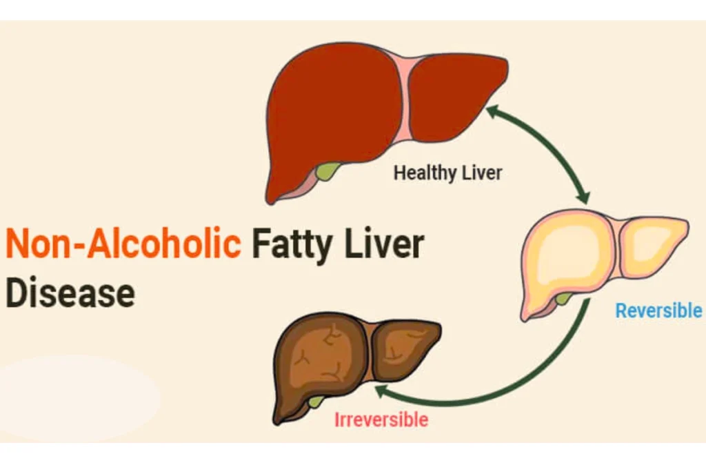 Non Alcoholic Fatty Liver Disease Treatment