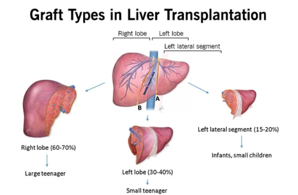 Types Of Liver Transplant