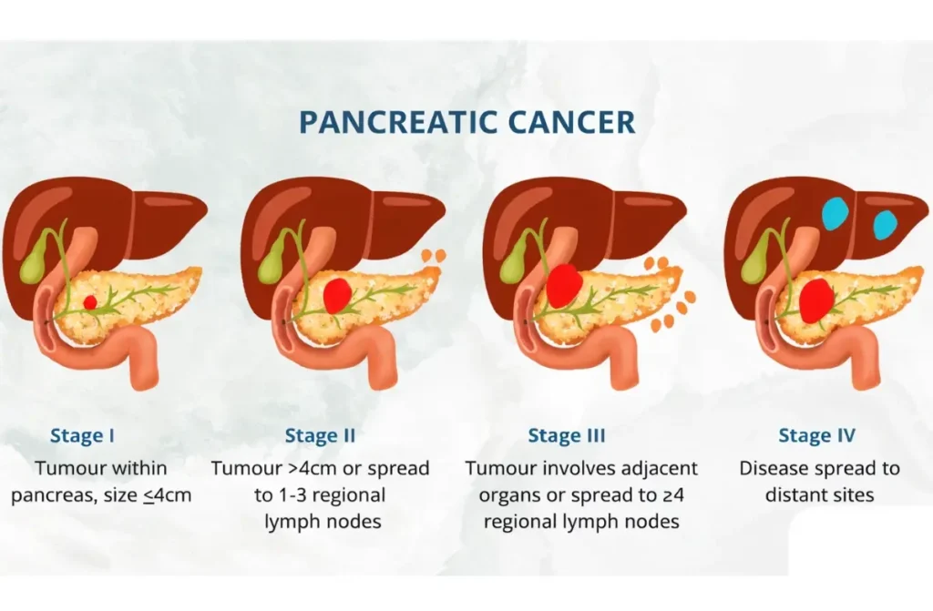 Stage 4 Pancreatic Cancer 1 1