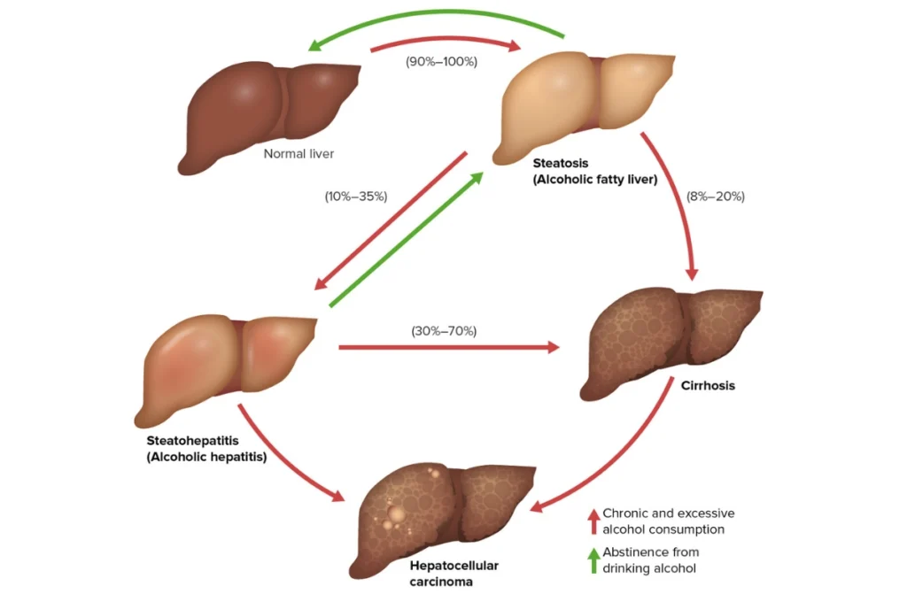 How Alcohol Affects Your Liver