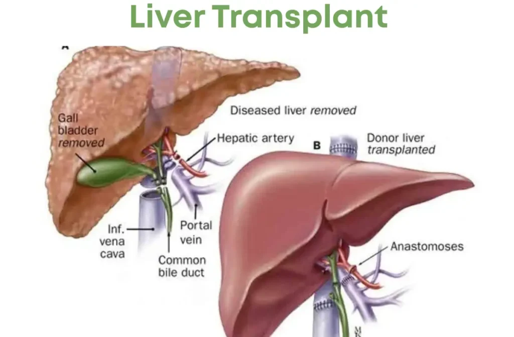 Liver transplant