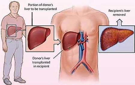 Best Liver Transplant Surgeon in India