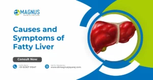 Causes and Symptoms of Fatty Liver