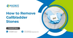How to Remove Gallbladder Stones