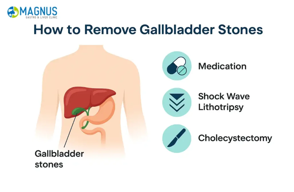 How to Remove Gallbladder Stones