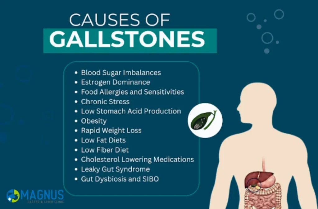 How to Remove Gallbladder Stones
