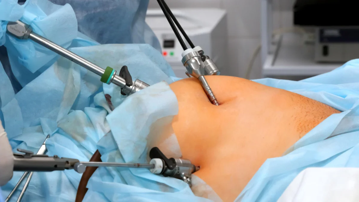 Laparoscopic Surgery in Chennai