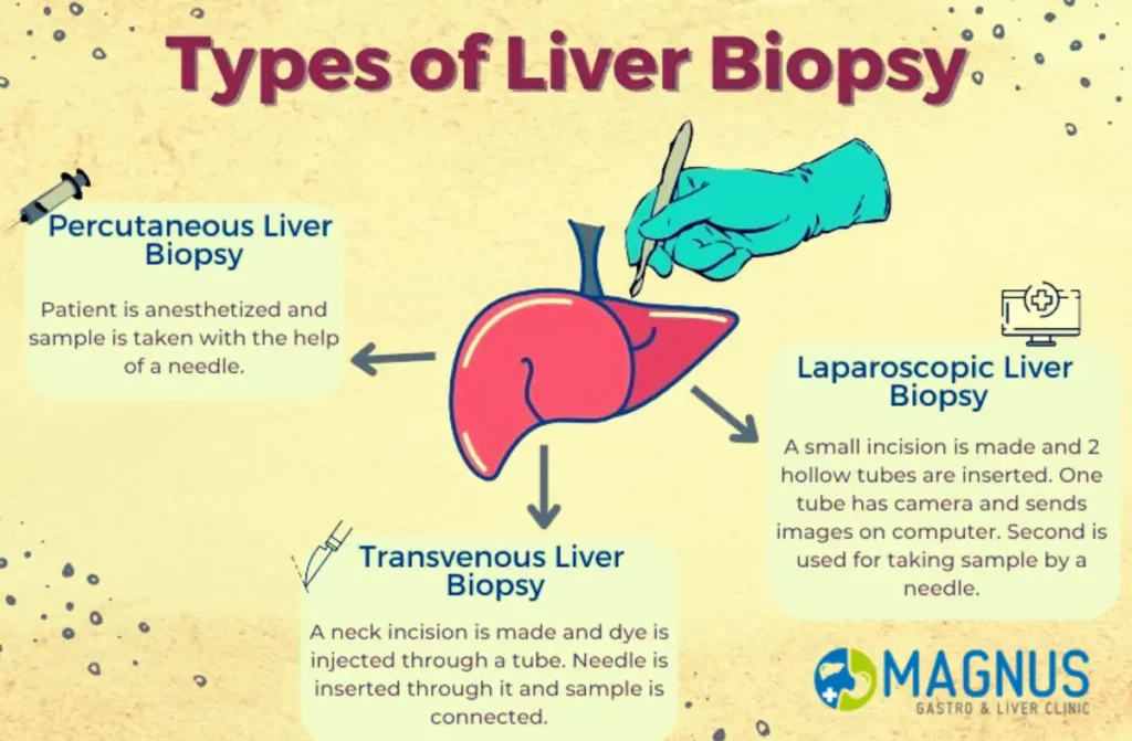 Liver Biopsy in Chennai