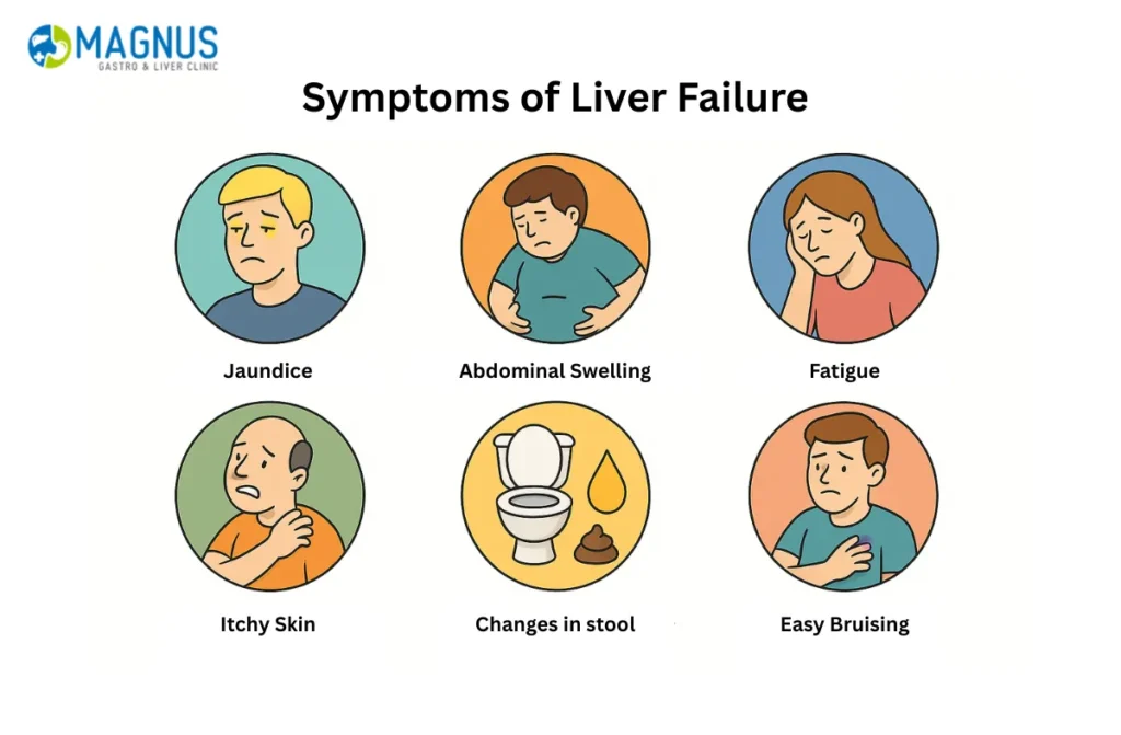 Signs of Liver Failure