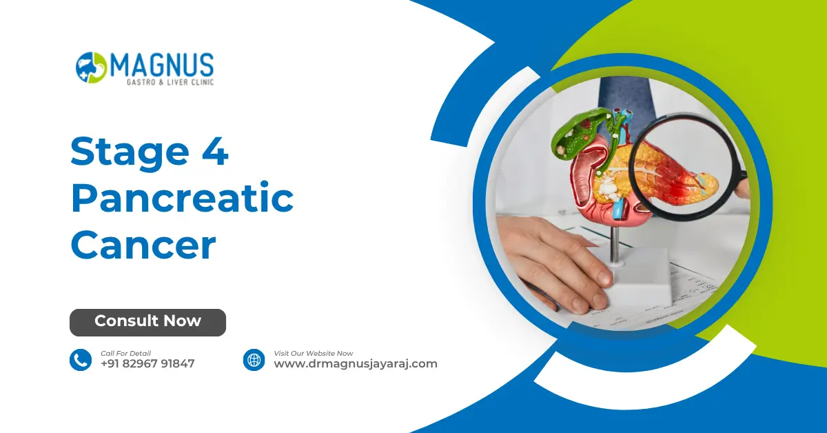 Stage 4 Pancreatic Cancer
